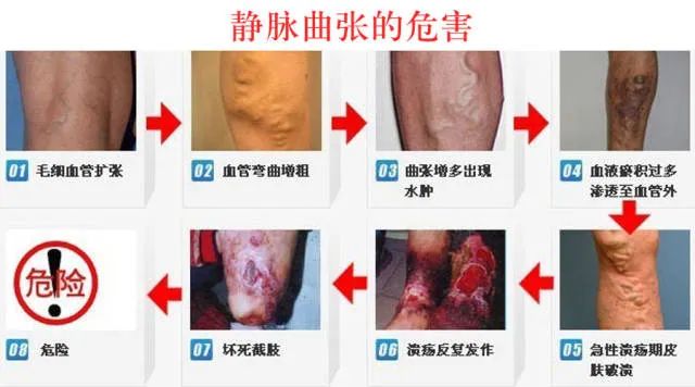 静脉曲张：.jpg